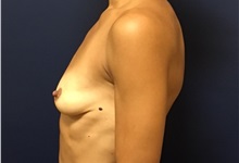 Breast Augmentation Before Photo by Brian Pinsky, MD, FACS; Huntington Station, NY - Case 35465