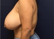 Breast Reduction Before Photo by Brian Pinsky, MD, FACS; Huntington Station, NY - Case 35468