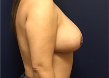 Breast Reduction After Photo by Brian Pinsky, MD, FACS; Huntington Station, NY - Case 35468