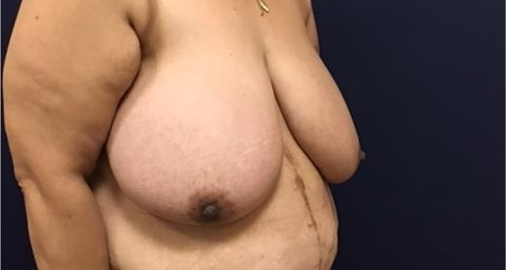Breast Reduction Before and After Photos by Brian Pinsky, MD, FACS;  Huntington Station, NY - Case 35471