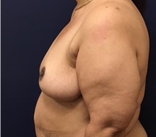 Breast Reduction After Photo by Brian Pinsky, MD, FACS; Huntington Station, NY - Case 35471