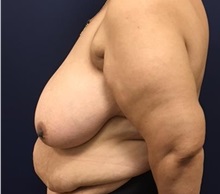 Breast Reduction Before Photo by Brian Pinsky, MD, FACS; Huntington Station, NY - Case 35471