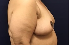 Breast Reduction After Photo by Brian Pinsky, MD, FACS; Huntington Station, NY - Case 35471