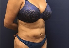 Liposuction After Photo by Brian Pinsky, MD, FACS; Huntington Station, NY - Case 35473