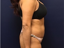 Liposuction Before Photo by Brian Pinsky, MD, FACS; Huntington Station, NY - Case 35473