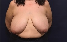 Breast Reduction Before Photo by Brian Pinsky, MD, FACS; Huntington Station, NY - Case 35476