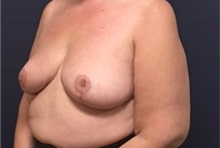 Breast Reduction After Photo by Brian Pinsky, MD, FACS; Huntington Station, NY - Case 35476