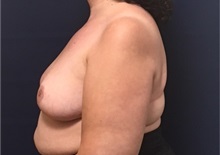 Breast Reduction After Photo by Brian Pinsky, MD, FACS; Huntington Station, NY - Case 35476