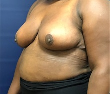 Breast Reduction After Photo by Brian Pinsky, MD, FACS; Huntington Station, NY - Case 35479