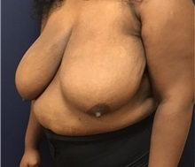 Breast Reduction Before Photo by Brian Pinsky, MD, FACS; Huntington Station, NY - Case 35479
