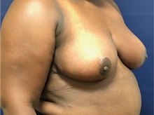 Breast Reduction After Photo by Brian Pinsky, MD, FACS; Huntington Station, NY - Case 35479
