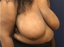 Breast Reduction Before Photo by Brian Pinsky, MD, FACS; Huntington Station, NY - Case 35479
