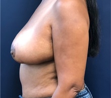 Breast Reduction After Photo by Brian Pinsky, MD, FACS; Huntington Station, NY - Case 35483
