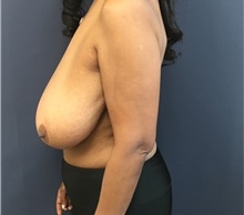 Breast Reduction Before Photo by Brian Pinsky, MD, FACS; Huntington Station, NY - Case 35483