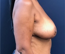 Breast Reduction After Photo by Brian Pinsky, MD, FACS; Huntington Station, NY - Case 35483