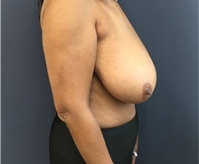 Breast Reduction Before Photo by Brian Pinsky, MD, FACS; Huntington Station, NY - Case 35483