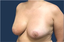 Breast Reduction After Photo by Brian Pinsky, MD, FACS; Huntington Station, NY - Case 35485