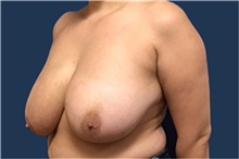 Breast Reduction Before Photo by Brian Pinsky, MD, FACS; Huntington Station, NY - Case 35485
