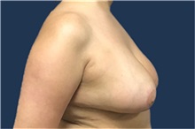 Breast Reduction After Photo by Brian Pinsky, MD, FACS; Huntington Station, NY - Case 35485