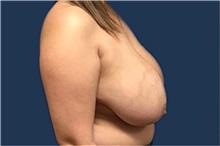 Breast Reduction Before Photo by Brian Pinsky, MD, FACS; Huntington Station, NY - Case 35485