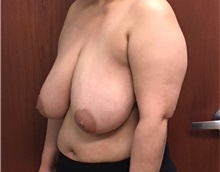 Breast Reduction Before Photo by Brian Pinsky, MD, FACS; Huntington Station, NY - Case 35488