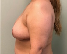 Breast Reduction After Photo by Brian Pinsky, MD, FACS; Huntington Station, NY - Case 35488