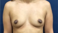 Breast Augmentation Before Photo by Brian Pinsky, MD, FACS; Huntington Station, NY - Case 35490