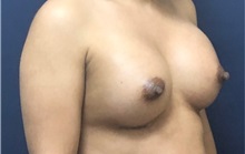 Breast Augmentation After Photo by Brian Pinsky, MD, FACS; Huntington Station, NY - Case 35490
