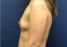 Breast Augmentation Before Photo by Brian Pinsky, MD, FACS; Huntington Station, NY - Case 35490
