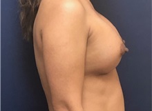 Breast Augmentation After Photo by Brian Pinsky, MD, FACS; Huntington Station, NY - Case 35490