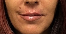 Lip Augmentation/Enhancement After Photo by Brian Pinsky, MD, FACS; Huntington Station, NY - Case 35491