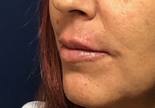 Lip Augmentation/Enhancement After Photo by Brian Pinsky, MD, FACS; Huntington Station, NY - Case 35491