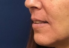 Lip Augmentation/Enhancement Before Photo by Brian Pinsky, MD, FACS; Huntington Station, NY - Case 35491