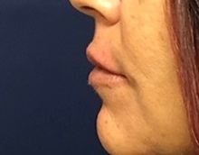 Lip Augmentation/Enhancement After Photo by Brian Pinsky, MD, FACS; Huntington Station, NY - Case 35491