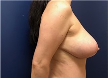Breast Reconstruction After Photo by Brian Pinsky, MD, FACS; Huntington Station, NY - Case 36510