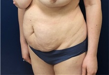Tummy Tuck Before Photo by Brian Pinsky, MD, FACS; Huntington Station, NY - Case 36511