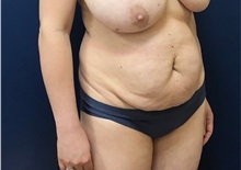 Tummy Tuck Before Photo by Brian Pinsky, MD, FACS; Huntington Station, NY - Case 36511
