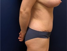 Tummy Tuck After Photo by Brian Pinsky, MD, FACS; Huntington Station, NY - Case 36511