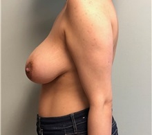 Breast Lift Before Photo by Brian Pinsky, MD, FACS; Huntington Station, NY - Case 37612