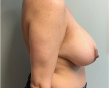 Breast Lift Before Photo by Brian Pinsky, MD, FACS; Huntington Station, NY - Case 37612