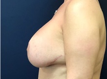 Breast Implant Revision Before Photo by Brian Pinsky, MD, FACS; Huntington Station, NY - Case 40832