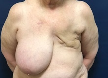 Breast Reconstruction Before Photo by Brian Pinsky, MD, FACS; Huntington Station, NY - Case 40835