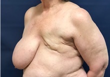 Breast Reconstruction Before Photo by Brian Pinsky, MD, FACS; Huntington Station, NY - Case 40835