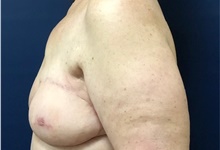 Breast Reconstruction After Photo by Brian Pinsky, MD, FACS; Huntington Station, NY - Case 40835