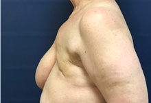 Breast Reconstruction Before Photo by Brian Pinsky, MD, FACS; Huntington Station, NY - Case 40835