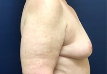 Breast Reconstruction After Photo by Brian Pinsky, MD, FACS; Huntington Station, NY - Case 40835