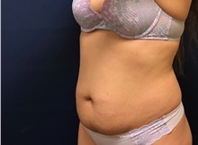 Tummy Tuck Before Photo by Brian Pinsky, MD, FACS; Huntington Station, NY - Case 41413