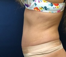 Tummy Tuck After Photo by Brian Pinsky, MD, FACS; Huntington Station, NY - Case 41413