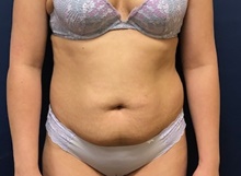 Liposuction Before Photo by Brian Pinsky, MD, FACS; Huntington Station, NY - Case 41414