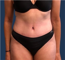 Tummy Tuck After Photo by Brian Pinsky, MD, FACS; Babylon, NY - Case 41415